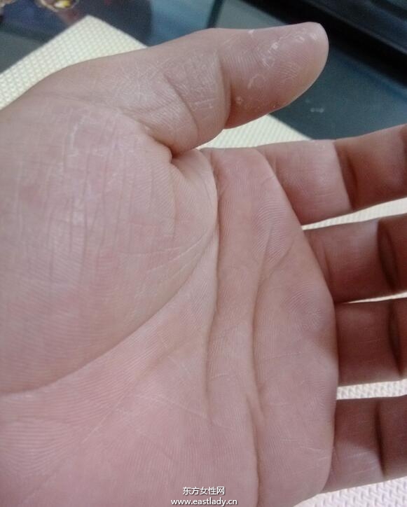 手上脱皮是怎么回事呢 轻松几招让你告别脱皮