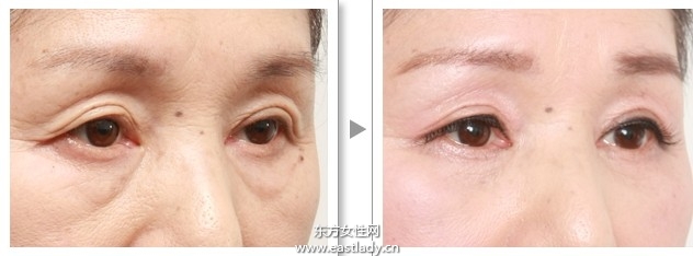 上眼皮突然下垂怎么办 这可能是疾病信号