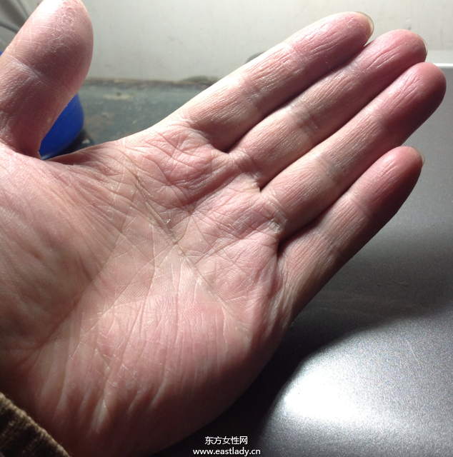 手上脱皮是怎么回事呢 轻松几招让你告别脱皮