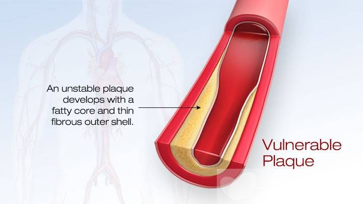 高血脂的治疗与饮食 最见效的食疗方法推荐