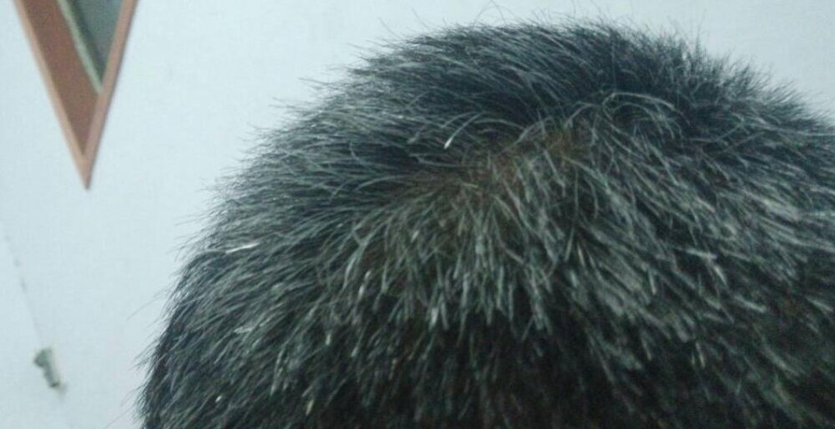 头发变白形成原因 看哪些你已中招