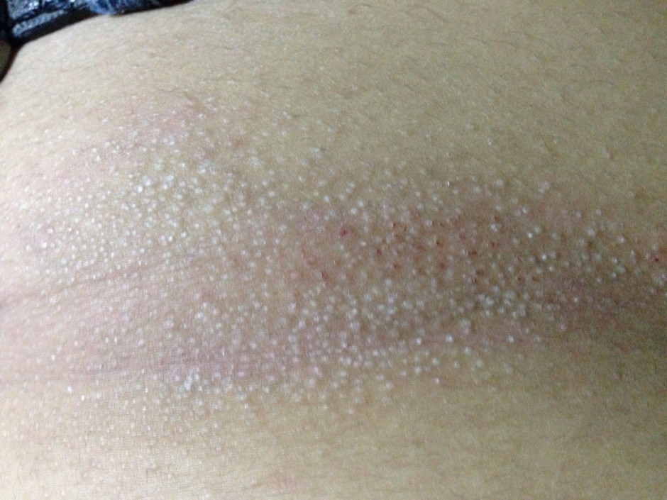 毛周角化是什么 揭你所不知的 鸡皮肤 治疗