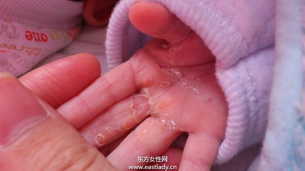 手上脱皮是怎么回事呢 轻松几招让你告别脱皮