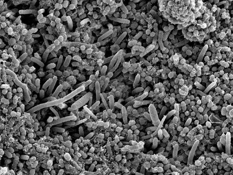 链球菌感染的不同表现 什么会导致链球菌感染