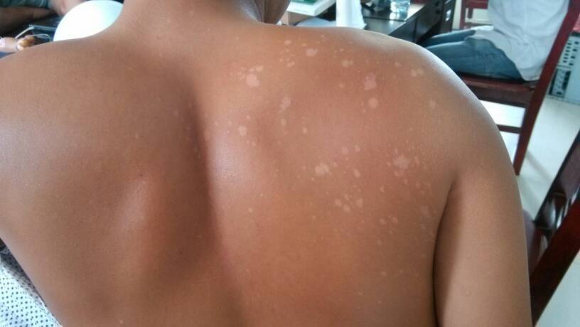 汗斑如何预防 荐5个有效治疗小妙招