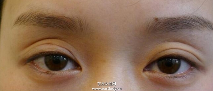 上眼皮突然下垂怎么办 这可能是疾病信号