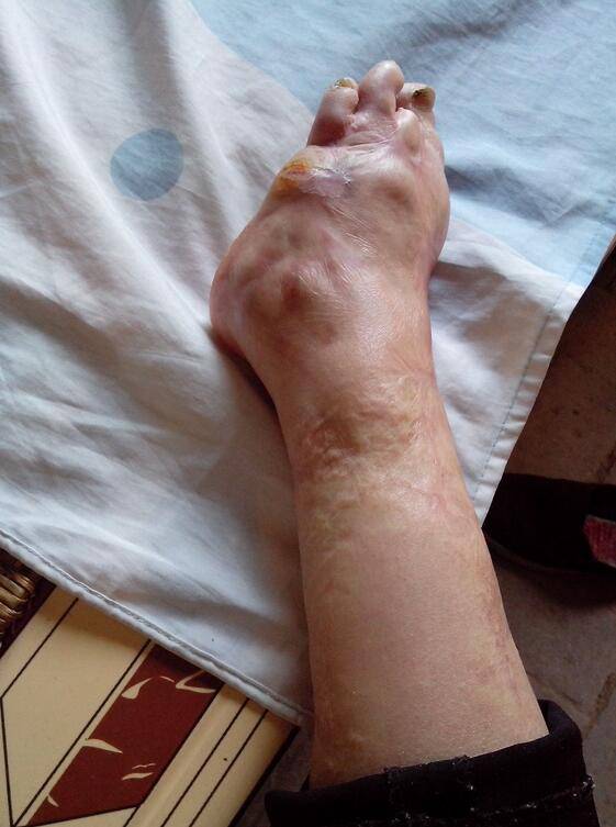 骨髓炎能治好吗 揭秘骨髓炎症状危害