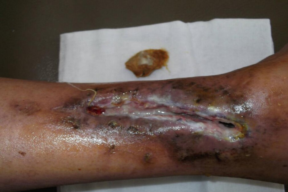 骨髓炎能治好吗 揭秘骨髓炎症状危害