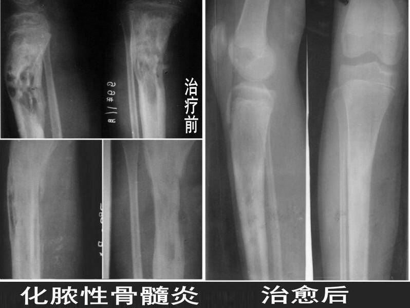 骨髓炎能治好吗 揭秘骨髓炎症状危害