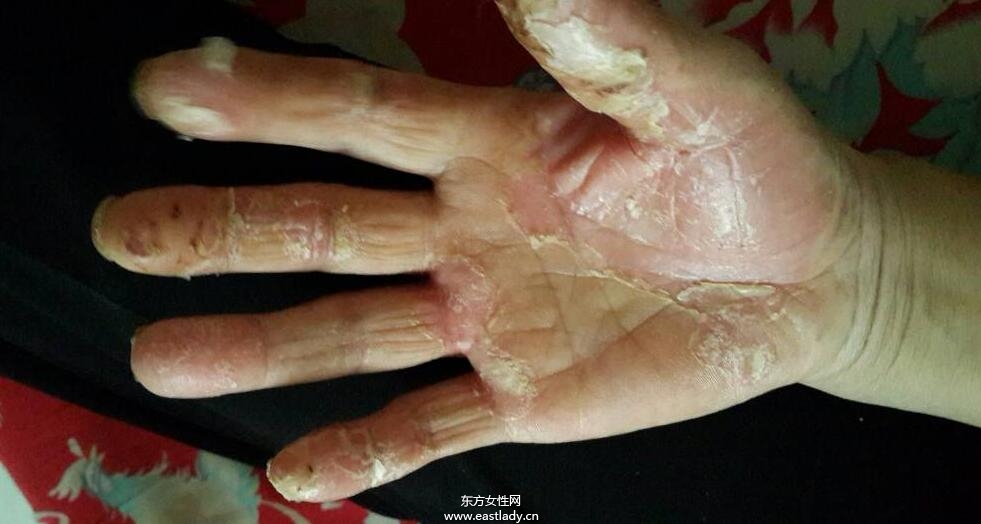 手上脱皮是怎么回事呢 轻松几招让你告别脱皮