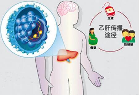 乙肝会传染吗 预防传染千万别做这些事