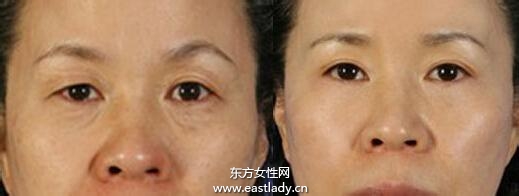 上眼皮突然下垂怎么办 这可能是疾病信号