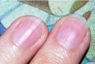 指甲上有竖纹是怎么回事 5个妙招教你如何调理