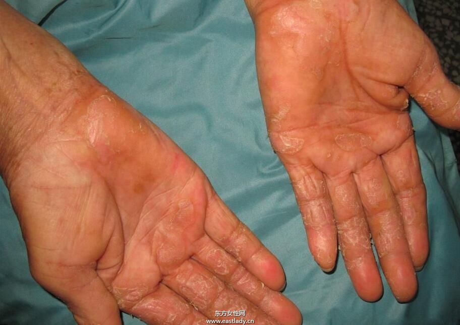 手上脱皮是怎么回事呢 轻松几招让你告别脱皮