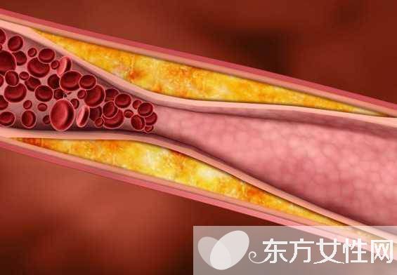 动脉硬化的症状表现有哪些 防止动脉硬化应多吃这些