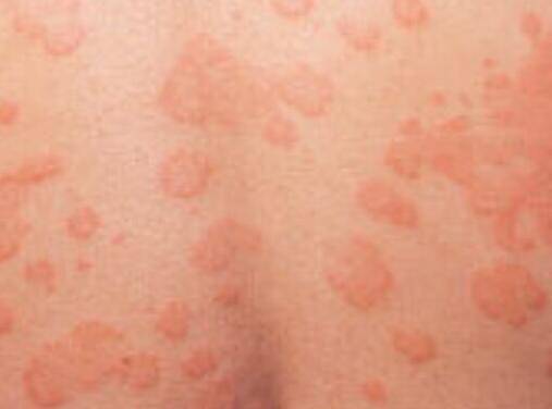 汗斑如何预防 荐5个有效治疗小妙招