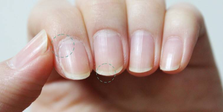 指甲上有竖纹是怎么回事 5个妙招教你如何调理