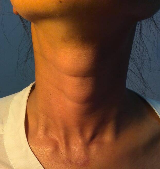 甲状腺癌术后饮食禁忌 解读甲状腺癌各类症状