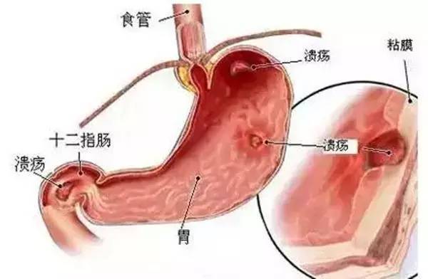 胃出血常见5大症状 胃出血最佳治疗方法