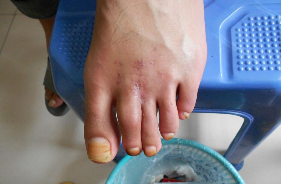 骨髓炎能治好吗 揭秘骨髓炎症状危害