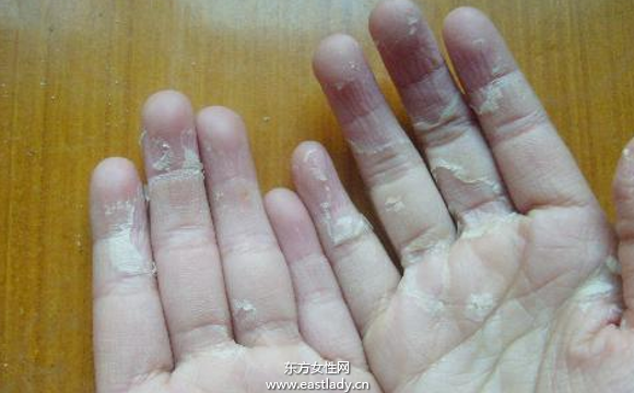 手上脱皮是怎么回事呢 轻松几招让你告别脱皮