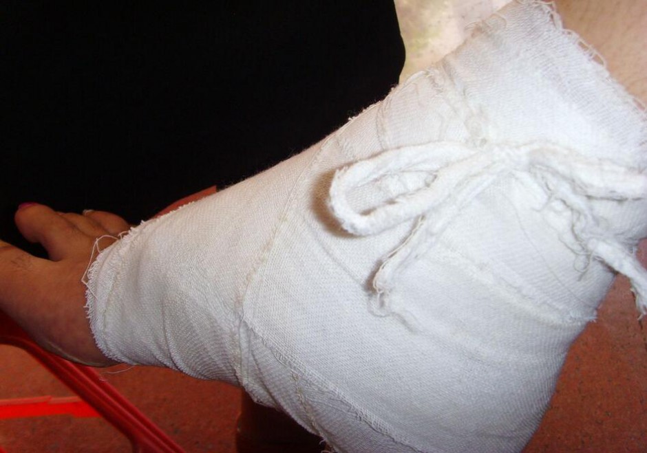 骨折愈合时间需要多久 愈合康复训练