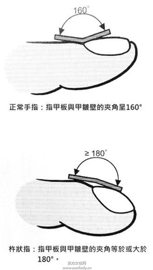 中医从 手指 看出心脏疾病