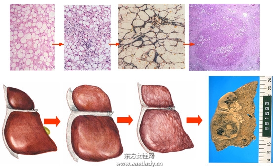 老中医手把手教你应当如何治疗肝病