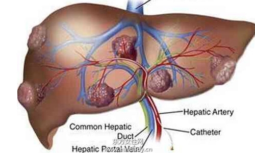 肝囊肿是怎么形成的 应该注意哪方面的饮食习惯