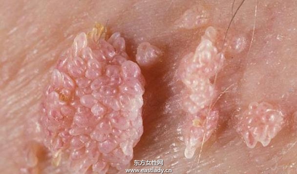 尖锐湿疣的潜伏期有多长时间