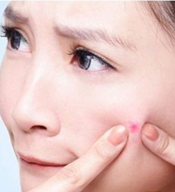 长痘痘怎么办 长痘痘能不能用手挤