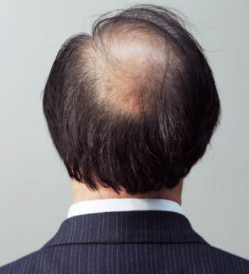 地中海脱发影响男人颜值 四招应对地中海脱发