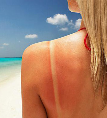 夏季晒伤了怎么办 推荐几款自制晒后修复面膜