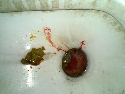 大便出血是什么原因以及大便出血怎么办