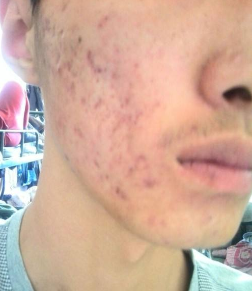 你该知道如何去除痘坑的几种方法