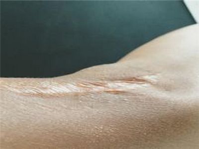 讨厌的疤痕快走开，怎么修复疤痕