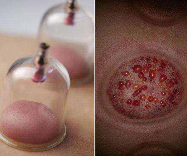 中医拔罐的种类以及功效你了解吗