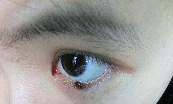 黑色素瘤和痣傻傻分不清 黑色素瘤和痣的区别