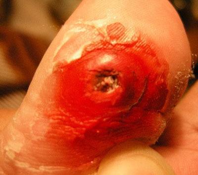 脚上长鸡眼怎么办 治疗鸡眼的祖传偏方