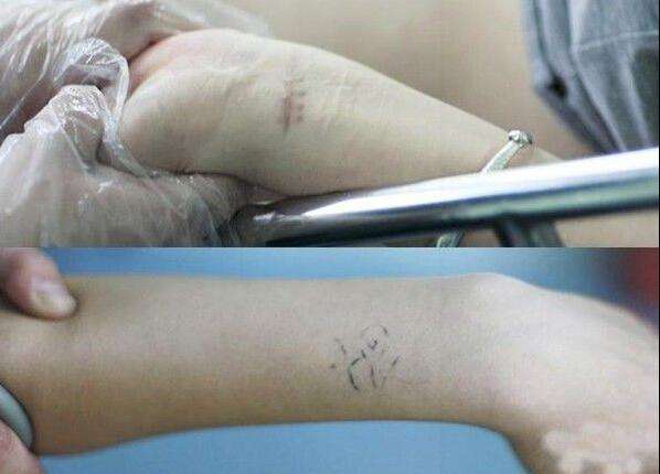 最后的补救措施 人流后多久可以出门