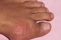 痛风的症状及治疗  进低嘌呤低能量饮食