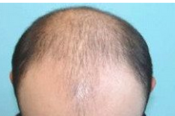 头发少怎么办  治疗脱发的偏方