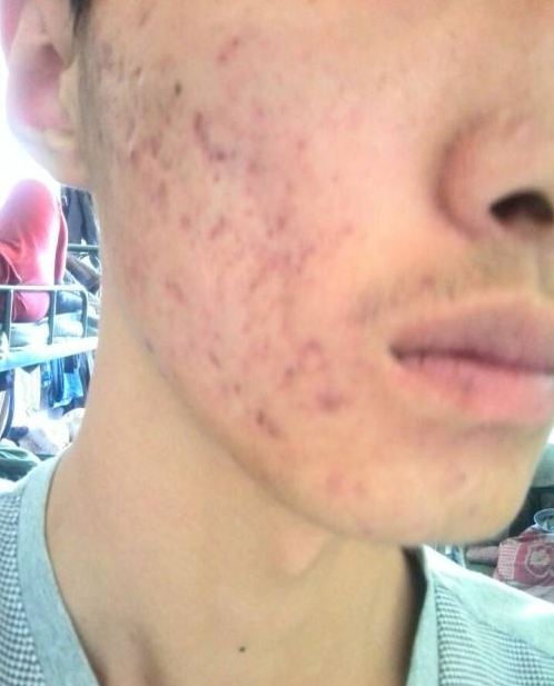 痘印怎么消除小妙招，这四种你要知道