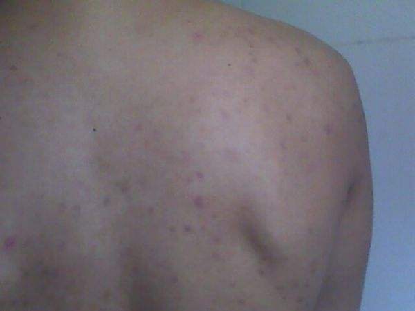 后背长痘痘是什么原因，可能是这6种原因