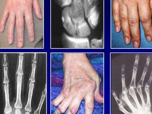 风湿和类风湿的区别你都知道吗