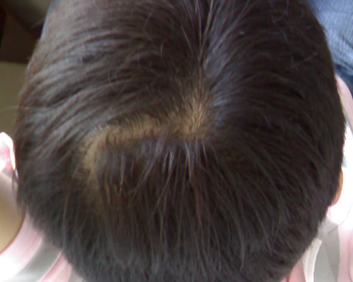 怎样去头皮屑，全方位为你解答