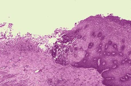 疱疹是怎么引起的以及治疗方法是什么