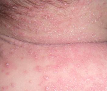 各种皮肤病治疗的小偏方 让你快速康复