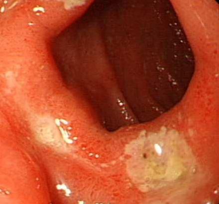 十二指肠炎的症状  表现有疼痛症状