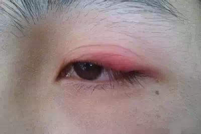 眼睛的门户 割双眼皮的坏处